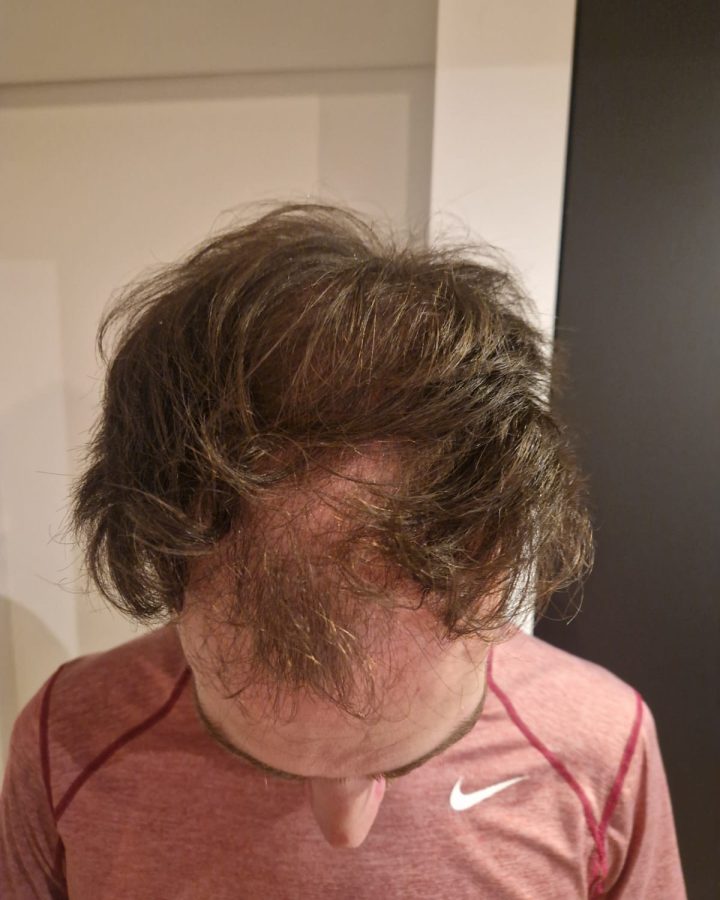 Voor behandeling: FUE 2200