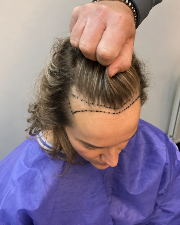 Voor behandeling: FUE 2320