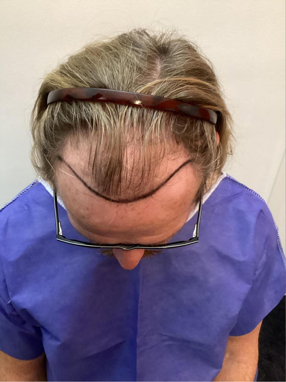 Voor behandeling: FUE 2430
