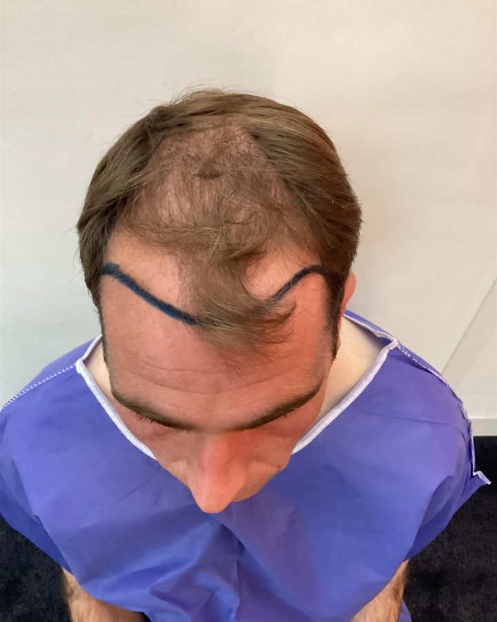 Voor behandeling: FUE 2200